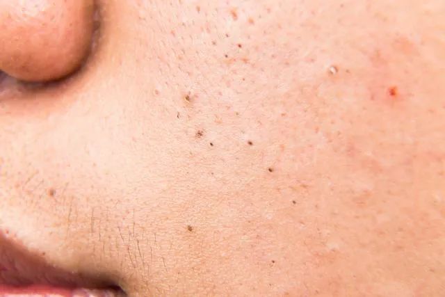 黑頭是怎么形成的？如何預(yù)防黑頭的產(chǎn)生？