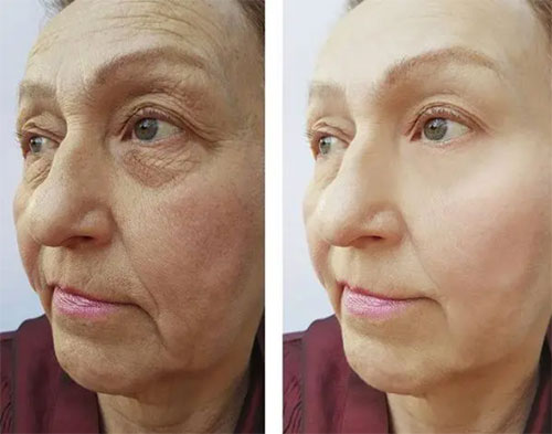 臉部松弛下垂如何改善？面部松弛下垂改善方法！